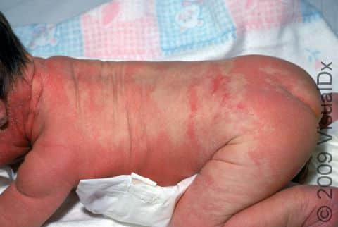 Seborrheic dermatitis can be severe, involving many skin areas.