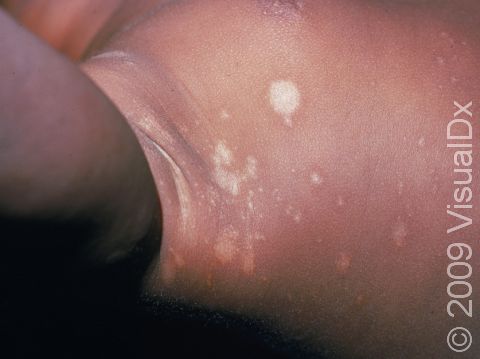In infants with darker skin, the inflammation in seborrheic dermatitis can lead to lightening of the skin (hypopigmentation).