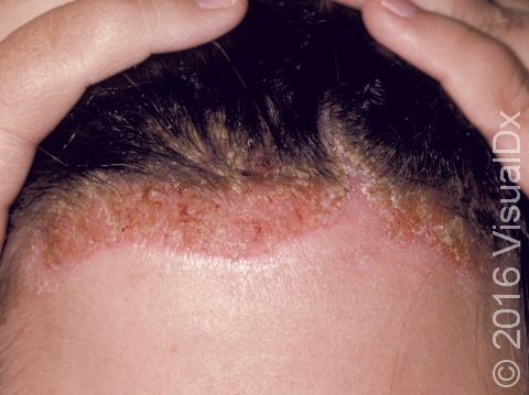 This image displays severe redness, scaling, and crust caused by seborrheic dermatitis.