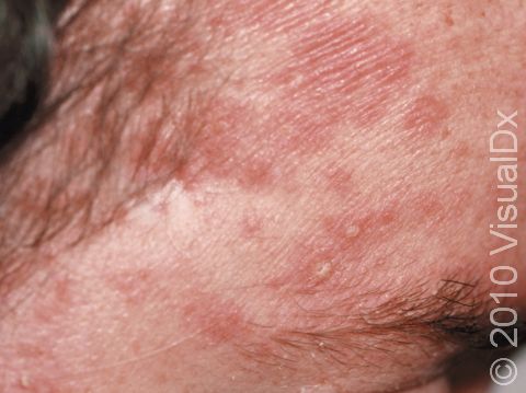 Seborrheic Dermatitis Condition, Treatments and Pictures for Adults -  Skinsight