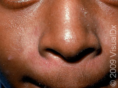 The faint redness and scale seen around the nose is typical of seborrheic dermatitis.