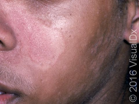 This image displays a patient with darker skin with inflammation caused by seborrheic dermatitis, which has lead to lightened pigment (hypopigmentation).