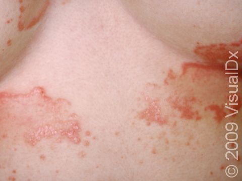 Seborrheic dermatitis can involve the chest and is accompanied by thin, mildly red elevations of the skin.