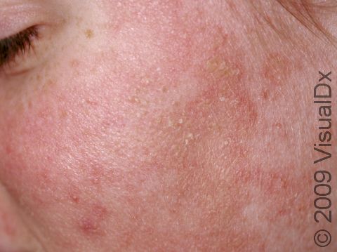 The fine, scaly, slightly elevated lesions of seborrheic dermatitis can be widespread on the face and scalp.