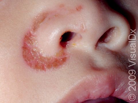 The fold of skin between the nose and cheek is frequently affected in seborrheic dermatitis.