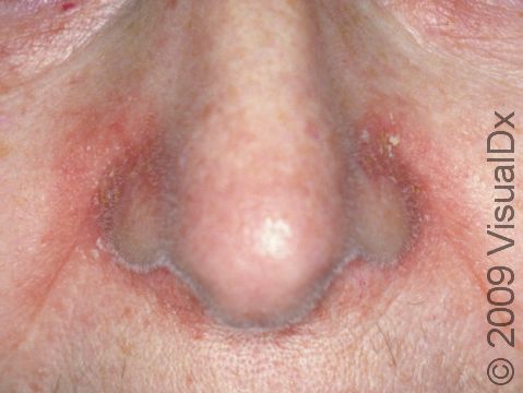 Redness and scaling often wraps around the nose in people with severe seborrheic dermatitis.