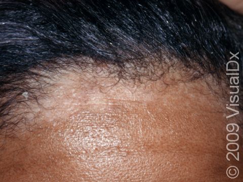 This image displays seborrheic dermatitis, which can involve the forehead, as seen here.