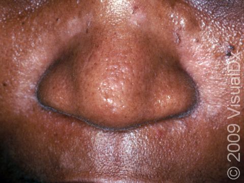 This image displays faint redness and scaling along the creases of the nose typical of seborrheic dermatitis on people with darker skin.