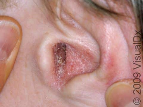 The red, scaling, and itching associated with seborrheic dermatitis are common in the ear canal.
