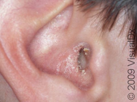 This image displays ear canal scaling and flaking caused by seborrheic dermatitis.