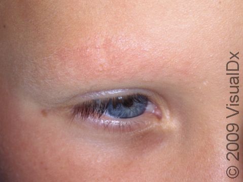 Mild redness (erythema) of eyebrows can be displayed, such as in this child with seborrheic dermatitis.