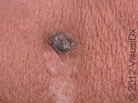Seborrheic keratoses are harmless thickenings of the outer layer of skin.