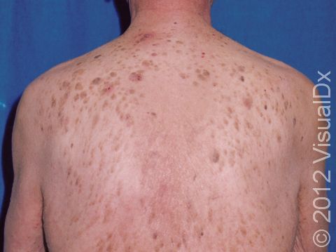 This image displays multiple brown, slightly elevated lesions typical of seborrheic keratoses.
