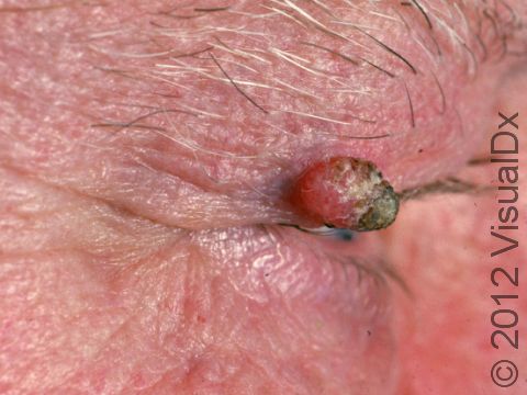 This image displays a raised lesion typical of seborrheic keratosis.