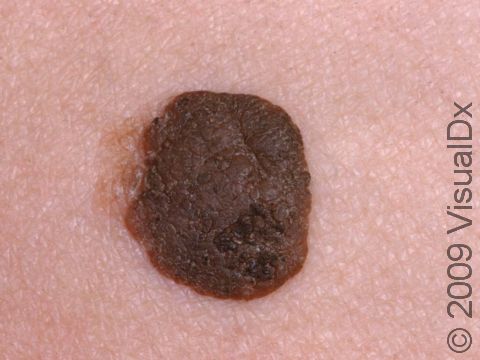 This image displays a lesion, with a sharp border and rough surface that appears to be sitting on top of the skin, typical of seborrheic keratosis.