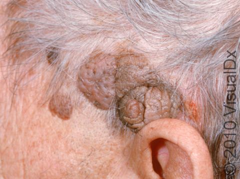 Seborrheic keratoses may become very large and lumpy in the scalp area. There are several on this man, which have grown into each other over time.