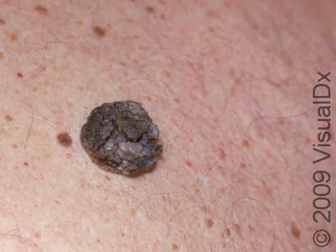 Typical to seborrheic keratoses, this image displays a brown, rough-appearing lesion.