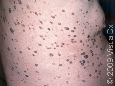 The dark to light brown raised, rough areas of seborrheic keratoses may be numerous in the elderly.