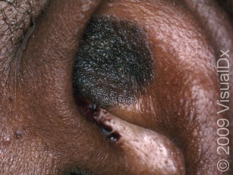 Dark brown, rough seborrheic keratoses may be found on any skin area, even inside the ear rim.