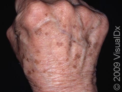 The backs of the hands commonly have solar lentigines (mistakenly called ?liver spots?).