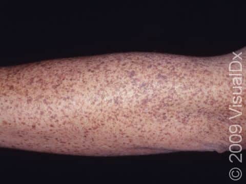 The highly sun-exposed back of the forearm shows more numerous solar lentigines than the inner forearm.