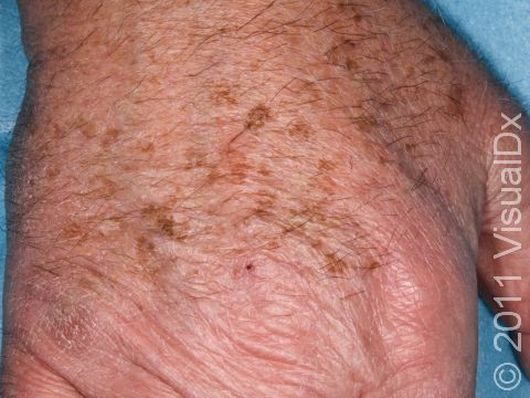 The medical term for sun and age freckles, as seen here, is solar lentigines.