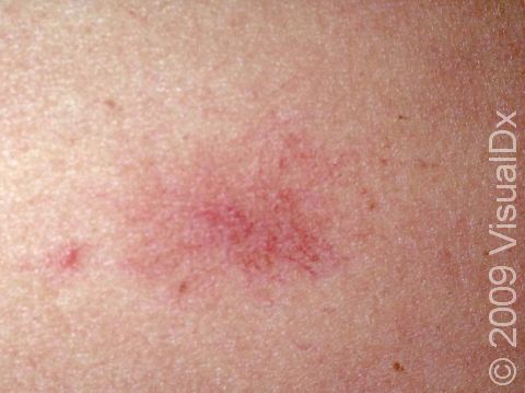 This image displays a spider angioma.