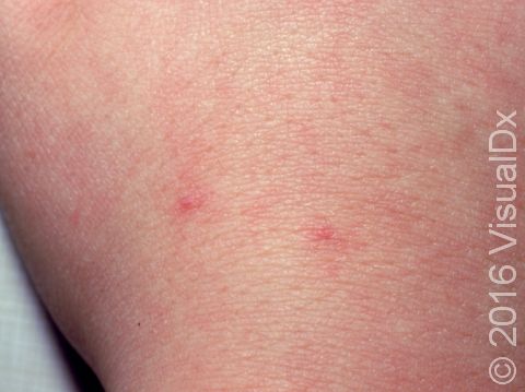 Spider angiomas are bright red, flat, and easily blanch when you press your finger on them.