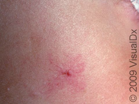 This image displays a typical spider angioma.