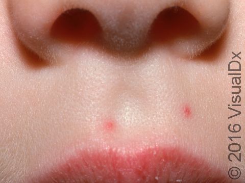 This image displays two spider angiomas on the upper lip.