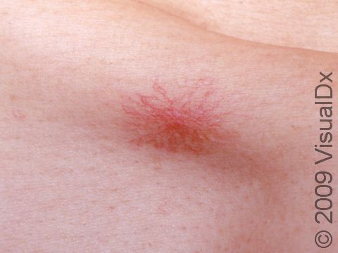 This flat spider angioma demonstrates why it is often called a 