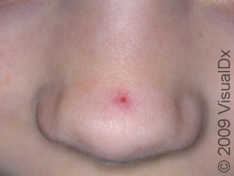 Spider angiomas are usually deep red but will fade easily when you press on the lesion with your finger.