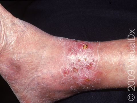 This area of redness, swelling, scaling, and itching just above the ankle is due to venous stasis.