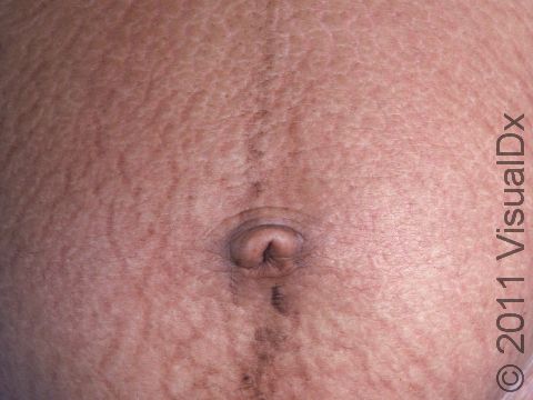 This image displays striae (stretch marks).