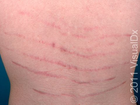 This image displays parallel stripes of red typical of striae (stretch marks).