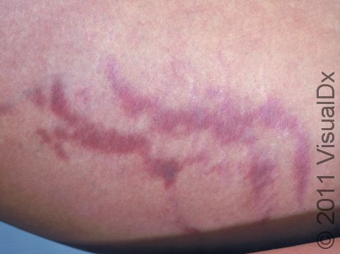 The inner thigh is a common place to see (striae) stretch marks in adolescence.