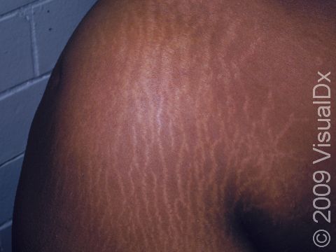 This image displays striae (stretch marks) on a shoulder.