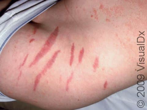 This image displays multiple parallel red-purple striae (stretch marks).