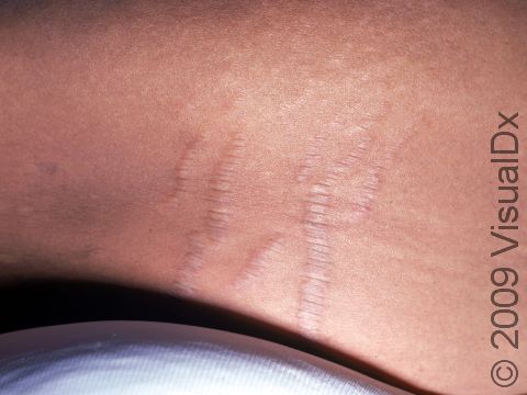 This image displays light-colored areas of skin that are thin and slightly elevated, typical of old striae (stretch marks).