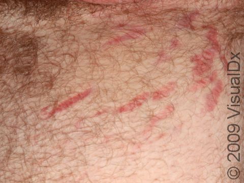 This image displays striae in the groin area of a rapidly growing young man.