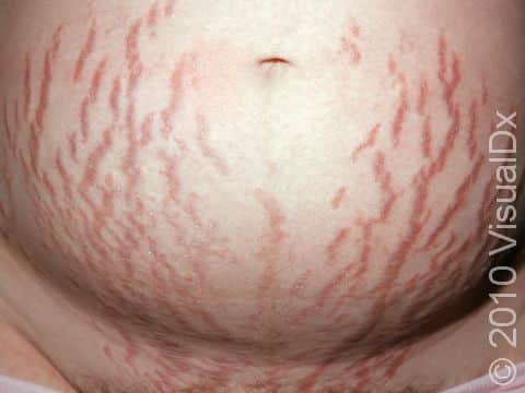 Dark purple, linear stretch marks (striae) are common on the belly of pregnant women.