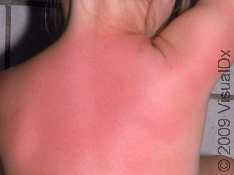This image displays a severe sunburn in a fair-skinned patient.