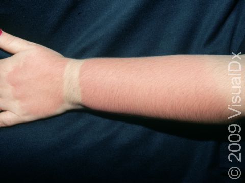 If this person wore more than a watch, such as sunscreen, she would have not gotten a sunburn.