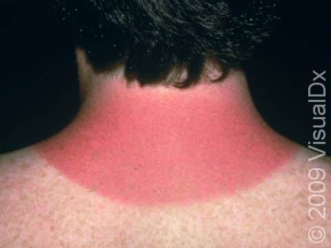 This image displays a sunburn.