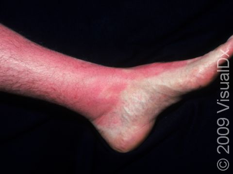 This image displays a sunburn on a patient who wore shoes but no sunblock.