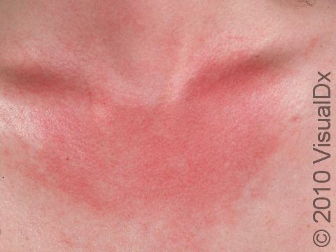 This image displays a woman with a mild sunburn on her chest.