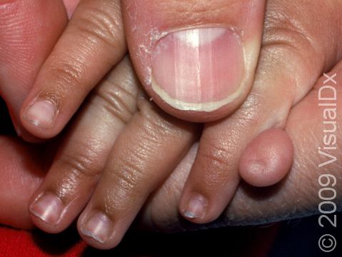 A soft, floppy extra finger remnant (supernumerary digit) is not uncommon on the outside of the fifth finger of a newborn.