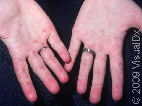 This image displays deep red and purple skin lesions due to inflammation of blood vessels with systemic lupus erythematosus.