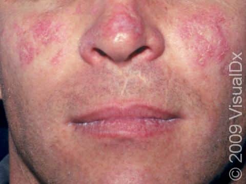 This image displays the cheeks and nose of a patient affected by systemic lupus that has been aggravated by exposure to the sun.