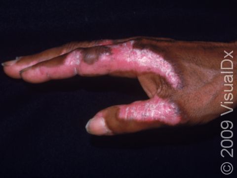 The rash of systemic lupus often involves the hands, as displayed in this image.